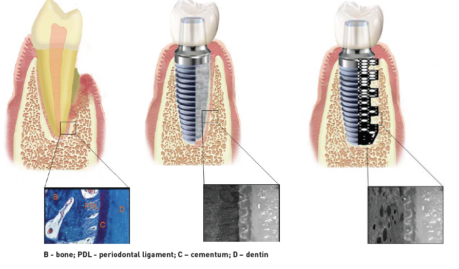 Toward Smart Dental Implants Mechanical Engineering
